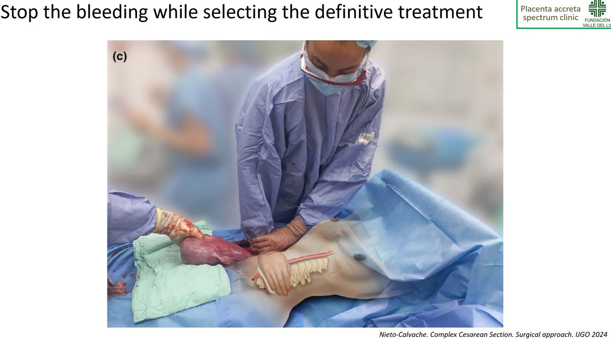 nieto_albaro's tweet photo. @PerinatalMedici @themis @cihatsen @AndreaDallAsta2 Finally.... some comments on protocolized treatment of complex cesarean section. Talks recording will be available for the registred participants in @PerinatalMedici Thanks @Themis Daklis and @cihatsen https://t.co/avPNIH6Ge4