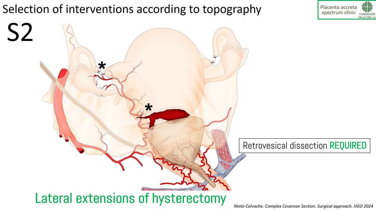 nieto_albaro's tweet photo. @PerinatalMedici @themis @cihatsen @AndreaDallAsta2 Finally.... some comments on protocolized treatment of complex cesarean section. Talks recording will be available for the registred participants in @PerinatalMedici Thanks @Themis Daklis and @cihatsen https://t.co/avPNIH6Ge4