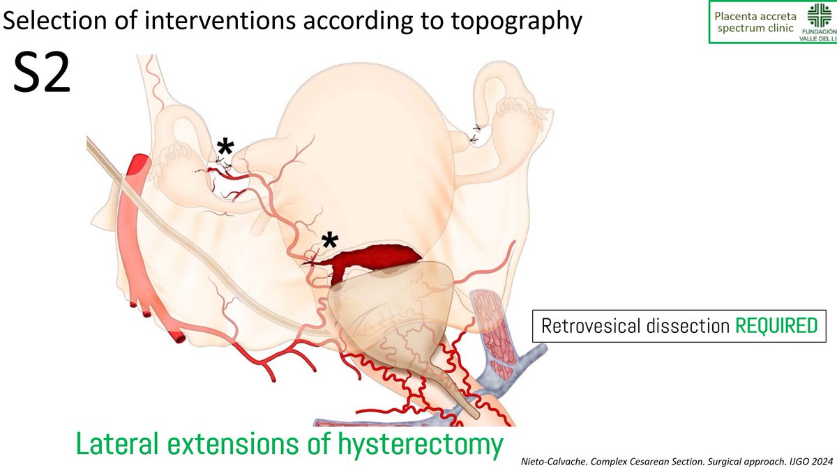 nieto_albaro's tweet photo. @PerinatalMedici @themis @cihatsen @AndreaDallAsta2 Finally.... some comments on protocolized treatment of complex cesarean section. Talks recording will be available for the registred participants in @PerinatalMedici Thanks @Themis Daklis and @cihatsen https://t.co/avPNIH6Ge4