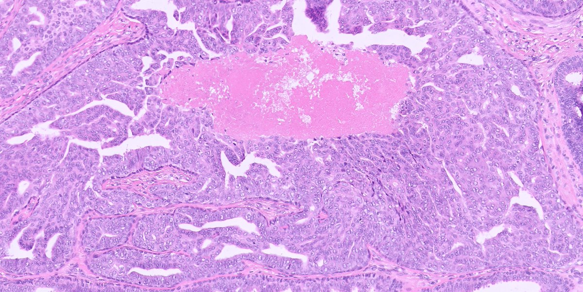 1/ A #breastpath case with section from the nipple 👇👇👇
some IHCs in the thread
#pathtwitter what is your diagnosis?
<a href="/mhassanaimc/">Masood Hassan</a>