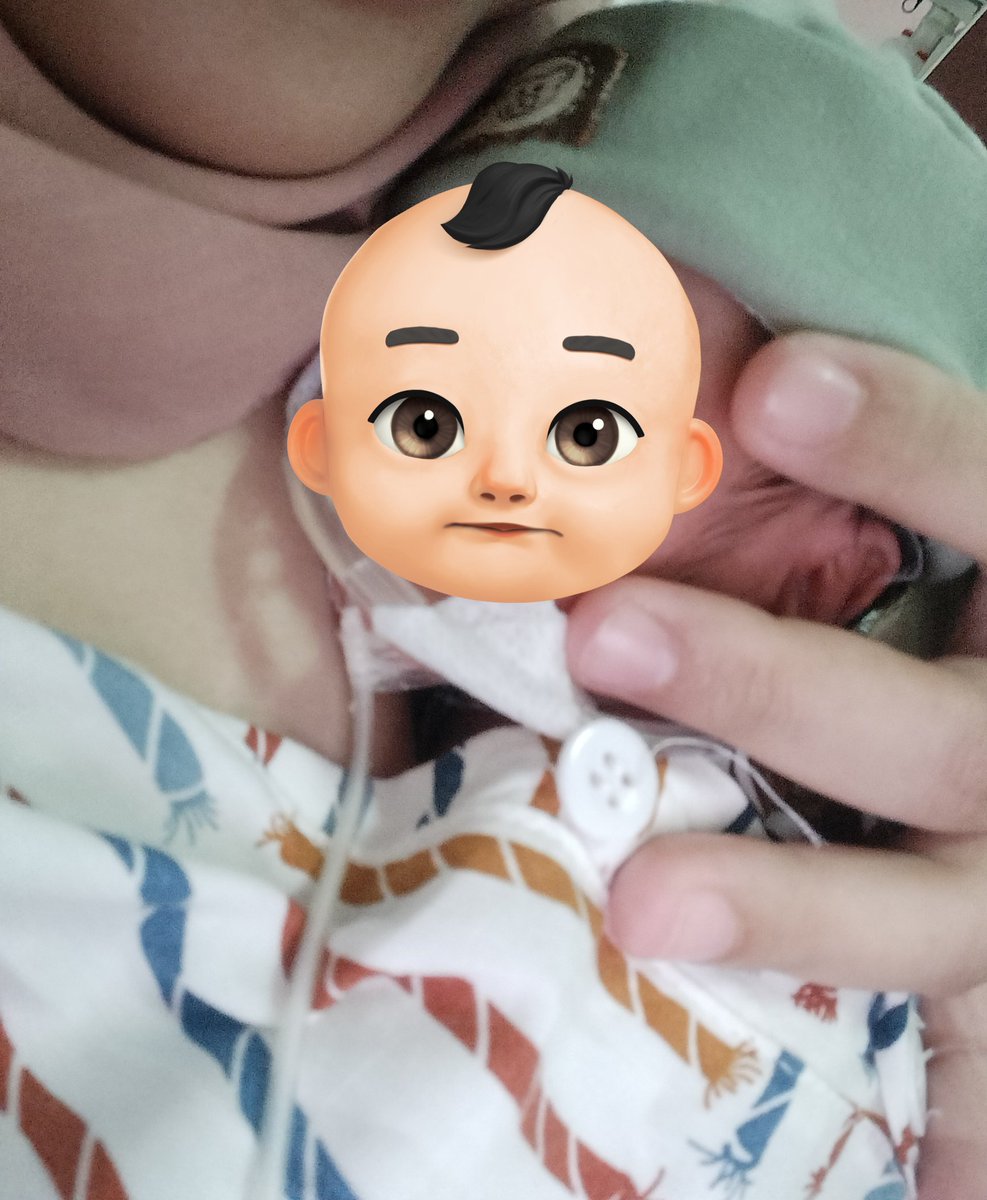 achelcs's tweet photo. Si baby dirawat selama 17 hari diruangan NICU. Tepatnya di tanggal 17 Feb udah dibolehin pulang, sempet KMC dulu dan skrining kesehatan si baby. Alhamdulillah, terima kasih banyak anakku udah berjuang bareng ibu, kamu hebat! 🥹🤍

(Struggle juga untuk kasih Asi, karna seret) -c https://t.co/EoXr6Zxmc5