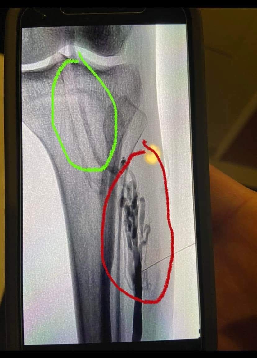 AmesStraight's tweet photo. This is a long shot..   my middle daughter has what they call a Venous Malformation  in her leg.    We have been to 7 different specialists..including one at MUSC in Mount Pleasant, SC... and none of them has been able to help her .  She had scelero therapy..and it didn't work.  It causes her pain 24/7 and is getting worse.  On top of this she has Type 1 diabetes...  she was diagnosed at age 11.    We don't know where  else to turn.    Please share this 
... I am hoping the right person will see it and can give us info on who can help her.    The red circle is the part that isn't right.    Looks like a tree with branches ...  when it should look like the part circled in green.    Those little veins are leading to nowhere.    🤷‍♀️