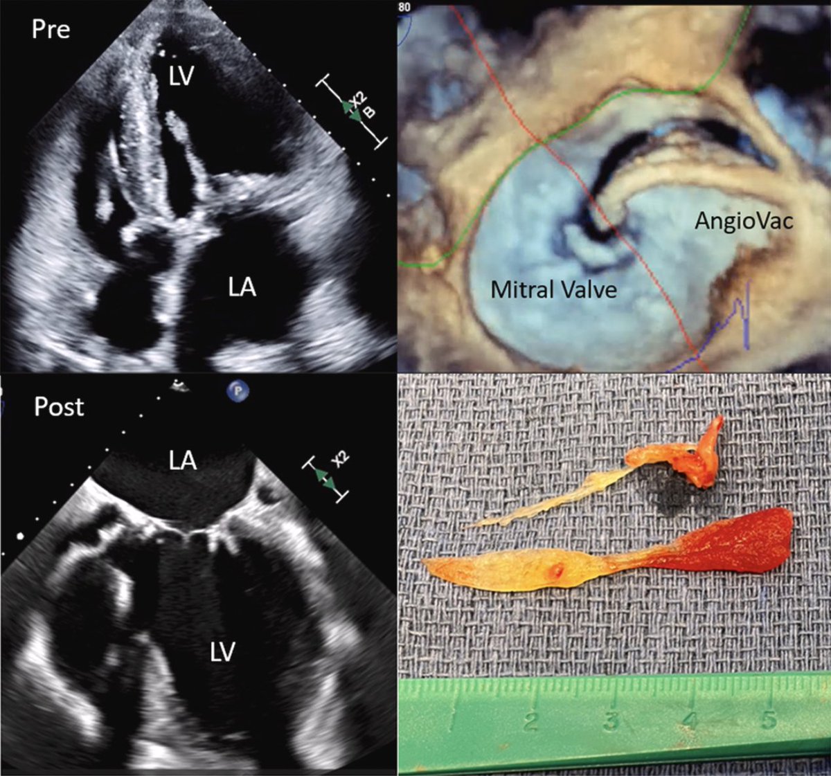 Check out our case in <a href="/JACCJournals/">JACC Journals</a> ; An 84yo female with a large bioprosthetic MV mass removed with transcatheter, transeptal vacuum aspiration.

<a href="/WMCCardsFellows/">Westchester Medical Center Cardiology Fellowship</a> <a href="/ShimamuraMD/">Junichi Shimamura</a> <a href="/SuguruOhira/">Suguru Ohira, MD, PhD</a>
#AngioVac

jacc.org/doi/10.1016/j.…