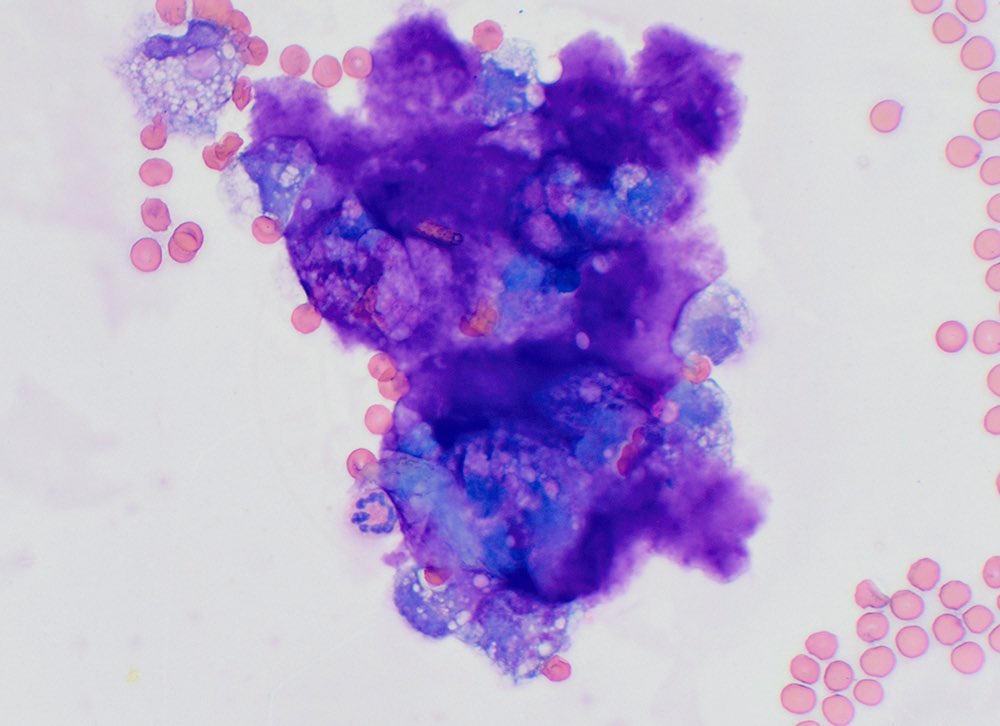 Macrophages surrounding and phagocytizing dark purple material (presumptive disc material) in the cerebrospinal fluid (CSF) of a 5 year old dog with an acute non-compressive nucleus pulposis extrusion. It is rare to see such material in CSF taps.