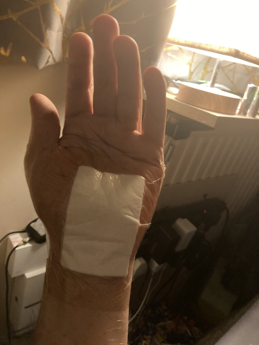 rick_heather's tweet photo. Bandage been off a couple of days now pain getting better unfortunately hand muscles still too weak to drive been told to give it 2 months https://t.co/F32vkZtOF6