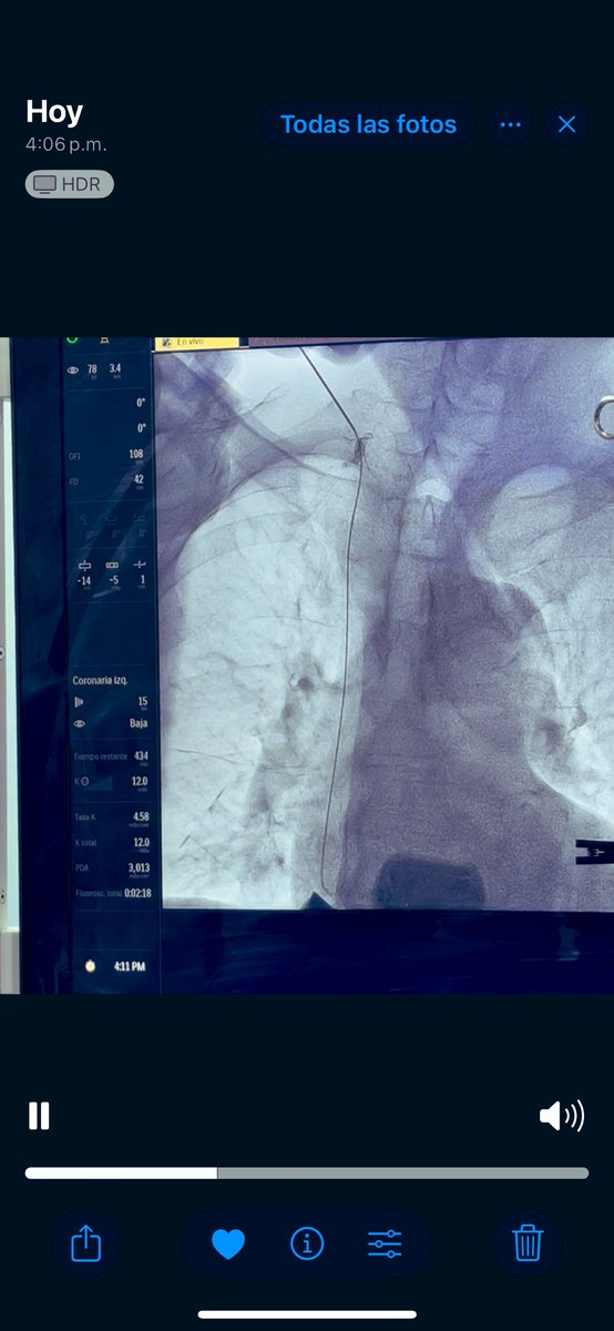 Hoy rescatamos a un paciente del catéter transauricular ingresando por vía yugualr externa, gracias a mi maestro  <a href="/arvizumh/">mauricio arvizu</a> <a href="/NefroINCMNSZ/">Departamento de Nefrología y Metabolismo Mineral</a>