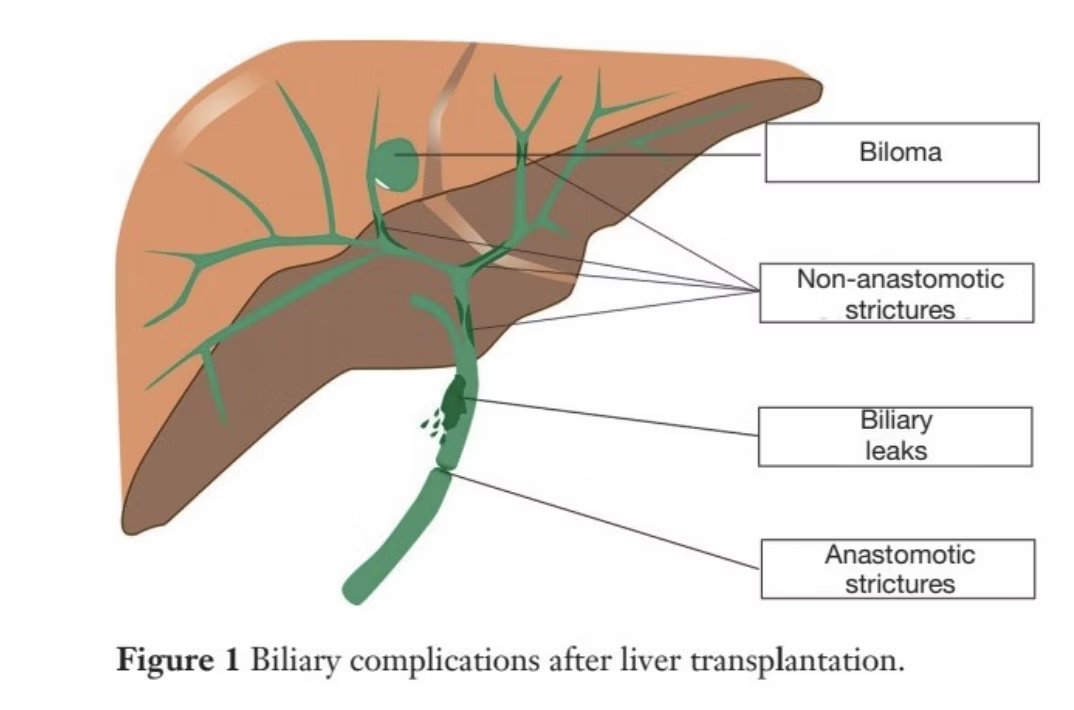 Biliary complications after liver transplantation