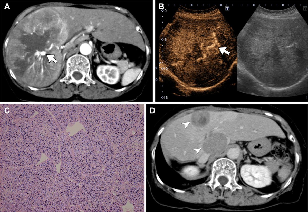 CT and MRI can noninvasively provide information about hepatobiliary and pancreatic tumor biology. Familiarity with the imaging findings and their applications contributes to selection of optimal treatments in the era of personalized medicine. bit.ly/4iD1gop