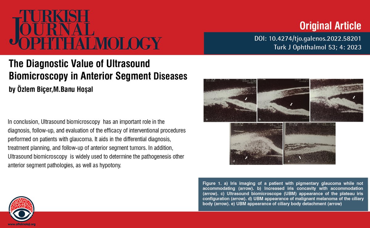 TurkJOphthalmol's tweet image. The Diagnostic Value of Ultrasound Biomicroscopy in Anterior Segment Diseases

You can see the free full text of the research by Özlem Biçer et al.

Link : oftalmoloji.org/articles/the-d…

#Ultrasoundbiomicroscopy #anteriorsegment #diseases #glaucoma