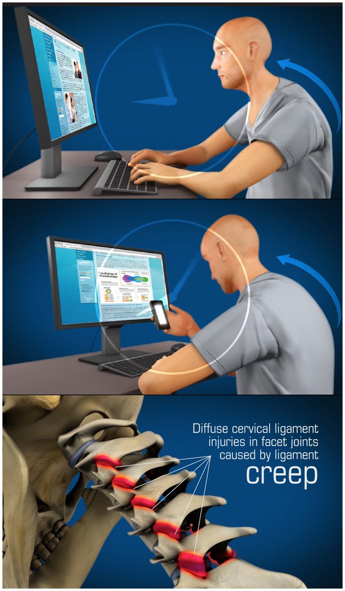 Be careful 😅🙈

The ligamentous cervical instability etiology of human disease from  the forward head-facedown lifestyle: emphasis on obstruction of fluid  flow into and out of the brain

frontiersin.org/journals/neuro…