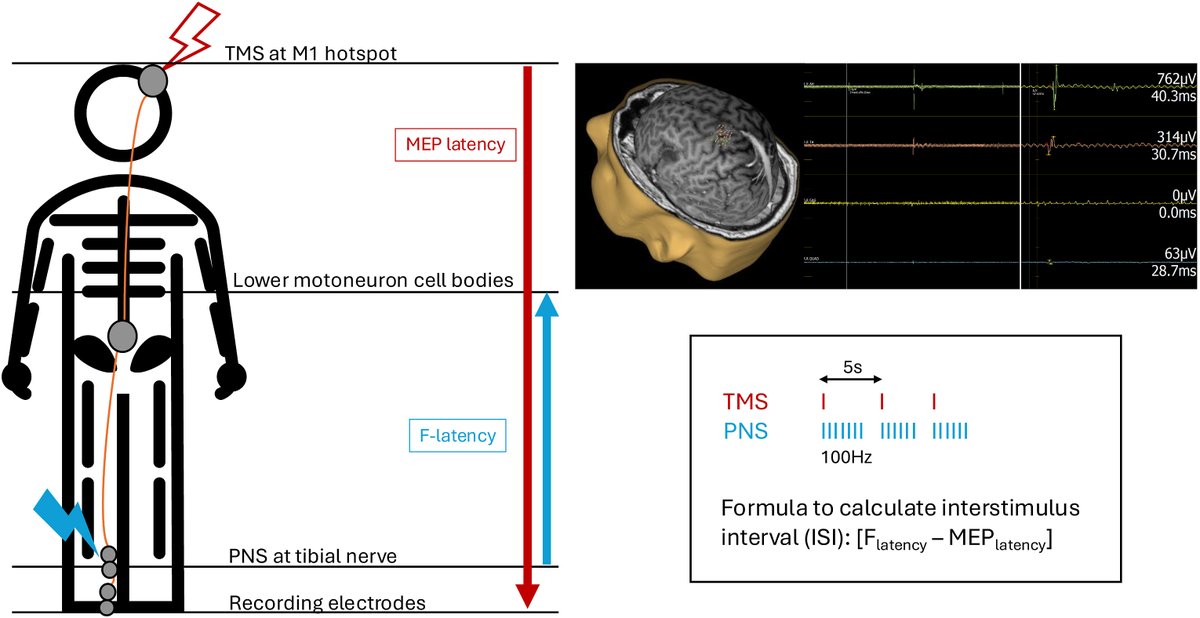 King's Neurosurgery (@kingsneuro) on Twitter photo Publication Alert!
We have published on "nTMS in #Spinal Cord Injury: current evidence, challenges and a future direction" <a href="/BrainSpineJ/">BrainandSpineJournal</a>.
doi.org/10.1016/j.bas.…
👉#nTMS: encouraging results in assessment and rehabilitation of #SCI
<a href="/JungJosephine/">Josephine Jung</a> <a href="/lavrador_jose/">José Pedro Lavrador</a> <a href="/Sabzp87/">Sabina</a> Publication Alert!
We have published on "nTMS in #Spinal Cord Injury: current evidence, challenges and a future direction" <a href="/BrainSpineJ/">BrainandSpineJournal</a>.
doi.org/10.1016/j.bas.…
👉#nTMS: encouraging results in assessment and rehabilitation of #SCI
<a href="/JungJosephine/">Josephine Jung</a> <a href="/lavrador_jose/">José Pedro Lavrador</a> <a href="/Sabzp87/">Sabina</a>