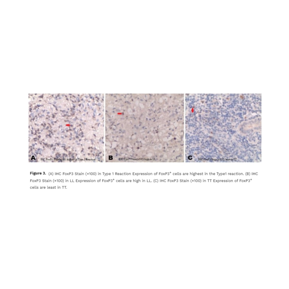 New in <a href="/LeprosyReview/">Leprosy Review</a> Volume 96/1:

An immunohistochemical study on T regulatory cells in Leprosy by Shailza Chaudhary, Ajay Malik, Seema Rani, and Shailesh Kumar

Read the paper: leprosyreview.org/article/96/1/2…

#Leprosy #Immunohistochemistry #IDTwitter #MedicalResearch