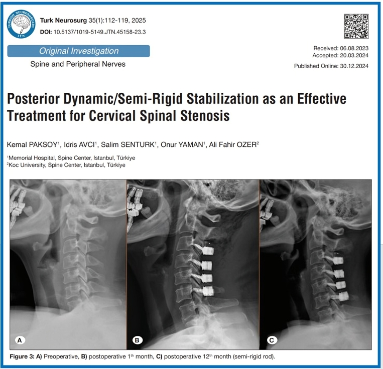JTN_Turkish's tweet photo. Breakthrough in cervical stenosis treatment! Semi-rigid stabilization rivals fusion: it provides equal pain relief and alignment at 1 year but slashes the risks of complications. Game-changer for spine surgery?

https://t.co/RHs8SmAbqf https://t.co/z7WpUQl4O8