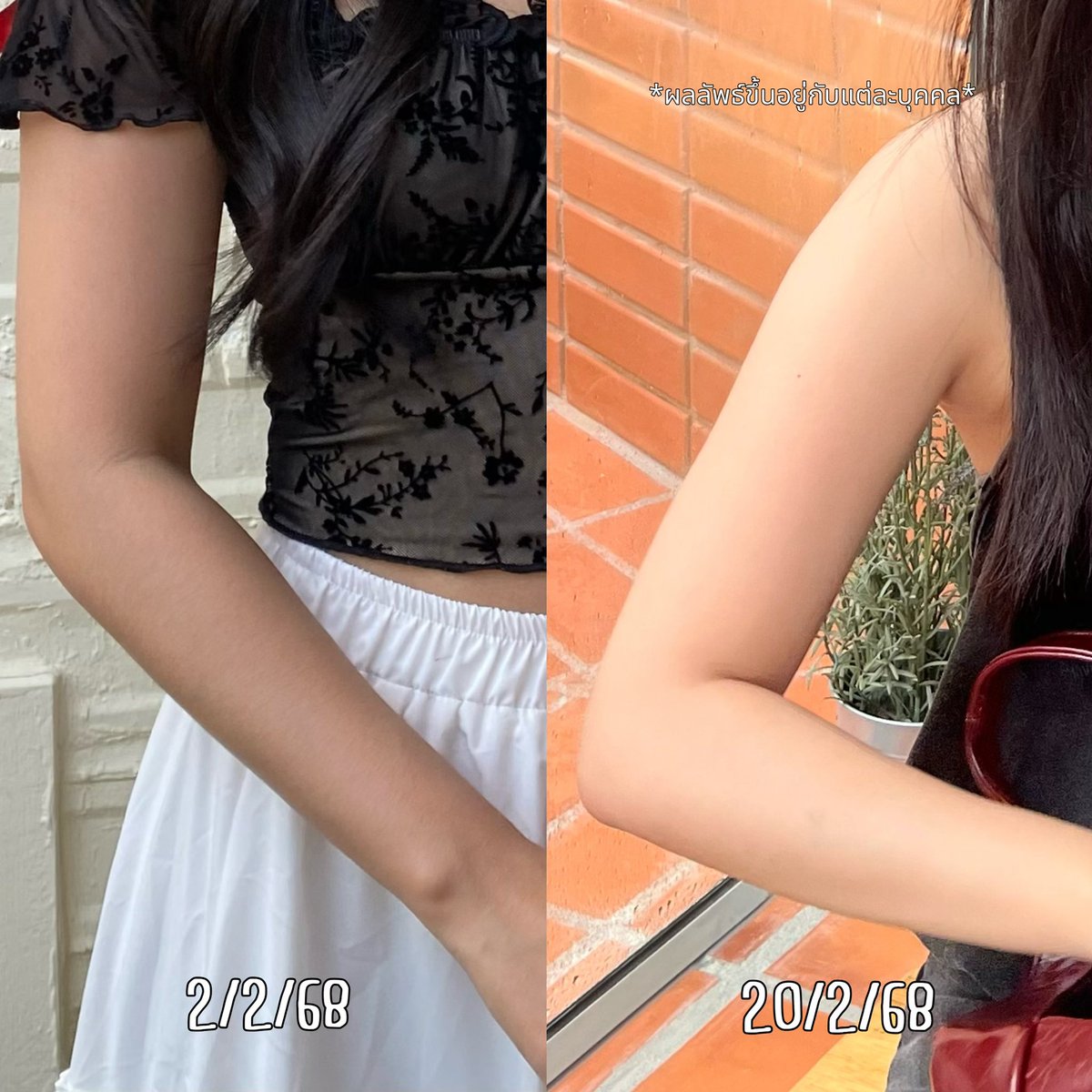 เป็นคนที่ไม่ค่อยชอบทากันแดดที่ตัวเวลาออกไปข้างนอก แล้วมีปัญหาสีผิวดูคล้ำขึ้น พอได้มาเจอ Eucerin Spotless Brightening Body Lotion ลองใช้ไป 2 สัปดาห์ ผิวดูกระจ่างใส สีผิวสม่ำเสมอขึ้น มีพวกรอยดำรอยแผลต่างๆก็จางลง เนื้อคือไม่เหนียว ซึมง่าย รักที่สุด💞
#EucerinThailand #โลชั่นผิวขาว #ไทอามิดอลบอดี้โลชั่น #รีวิวสกินแคร์
