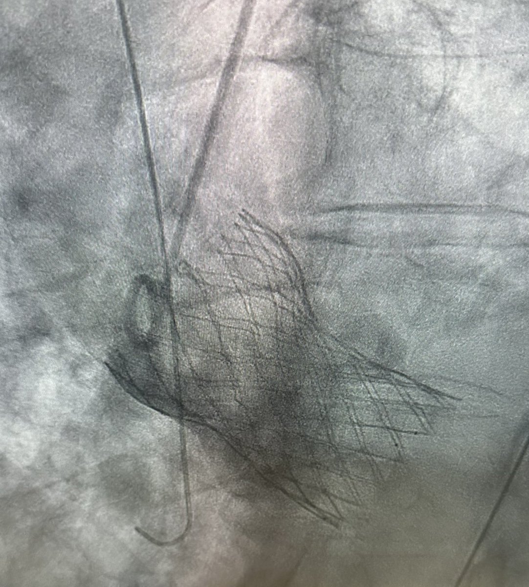 CorazonHuvr (@corazonhuvr) on Twitter photo TAVI number 1000 in our institution. May not seem much but it means a lot to us. Highly calcified Type -1 bicuspid aortic stenosis. Excellent result. <a href="/pepp183/">jose diaz</a> <a href="/Monicaferqu/">MĂłnica Fernández Quero</a> <a href="/niemed21/">Nieves Romero</a> @HospUVRocio <a href="/shci_sec/">ACI-SEC: Hemodinamica</a> <a href="/belcid7/">BelĂ©n Cid Alvarez</a> <a href="/MPAOSS/">Manuel Pan</a> <a href="/secardiologia/">Soc Esp CardiologĂa</a> <a href="/SACardiologia/">SACardiologĂa</a> TAVI number 1000 in our institution. May not seem much but it means a lot to us. Highly calcified Type -1 bicuspid aortic stenosis. Excellent result. <a href="/pepp183/">jose diaz</a> <a href="/Monicaferqu/">MĂłnica Fernández Quero</a> <a href="/niemed21/">Nieves Romero</a> @HospUVRocio <a href="/shci_sec/">ACI-SEC: Hemodinamica</a> <a href="/belcid7/">BelĂ©n Cid Alvarez</a> <a href="/MPAOSS/">Manuel Pan</a> <a href="/secardiologia/">Soc Esp CardiologĂa</a> <a href="/SACardiologia/">SACardiologĂa</a>