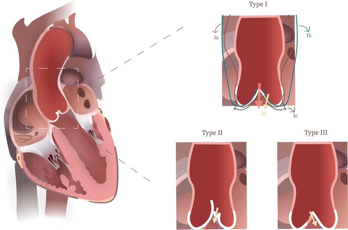 What are the outcomes and mid-term results for aortic valve repair in Colombia, a middle-income country? Surgeons there report aortic valve repair emerged as an effective and durable procedure. Read more in #JTCVS Open: doi.org/10.1016/j.xjon…