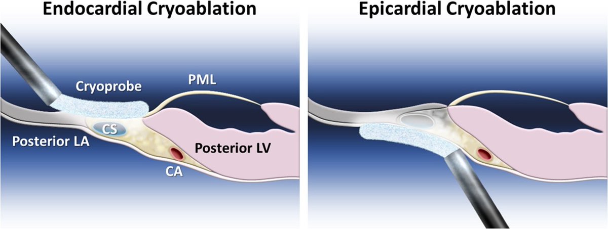 New adult arrhythmia research: Incomplete ablation as a mechanism of atrial fibrillation recurrence and atrial tachycardia development after maze procedure from Nippon Medical School. Read more in #JTCVS Open: doi.org/10.1016/j.xjon…
