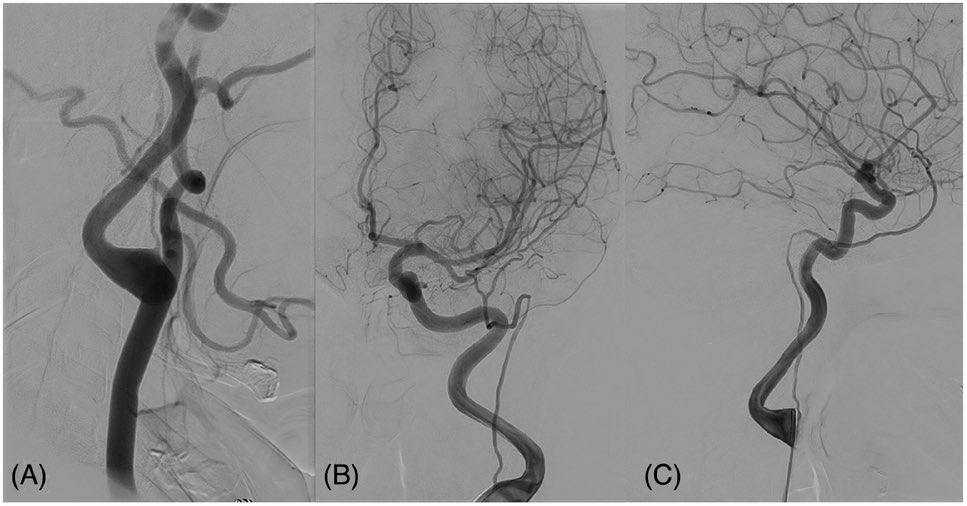 AshuJadhav (@ashupjadhav) on Twitter photo Pharyngo‐Tympano‐Stapedial Variant of the Middle Meningeal Artery | Stroke: Vascular and Interventional Neurology ahajournals.org/doi/10.1161/SV… <a href="/StrokeAHA_ASA/">Stroke AHA/ASA</a> <a href="/svinsociety/">SVIN</a> <a href="/SVINJournal/">Stroke: Vascular and Interventional Neurology</a> Pharyngo‐Tympano‐Stapedial Variant of the Middle Meningeal Artery | Stroke: Vascular and Interventional Neurology ahajournals.org/doi/10.1161/SV… <a href="/StrokeAHA_ASA/">Stroke AHA/ASA</a> <a href="/svinsociety/">SVIN</a> <a href="/SVINJournal/">Stroke: Vascular and Interventional Neurology</a>