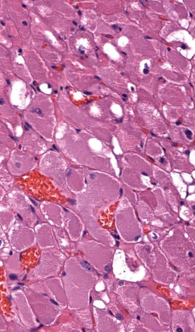 JMGardnerMD's tweet photo. 50 yo M. Floor of mouth mass. Look closely at cytoplasm. Diagnosis? 
WSI digital slide (a FANTASTIC EXAMPLE of this entity!): https://t.co/HEg5mbW4nf. 
Answer ✅ https://t.co/qRRLnq3BRL 
#BSTpath #pathologists #pathology #pathTwitter #ENTpath https://t.co/adyGsGHBwk