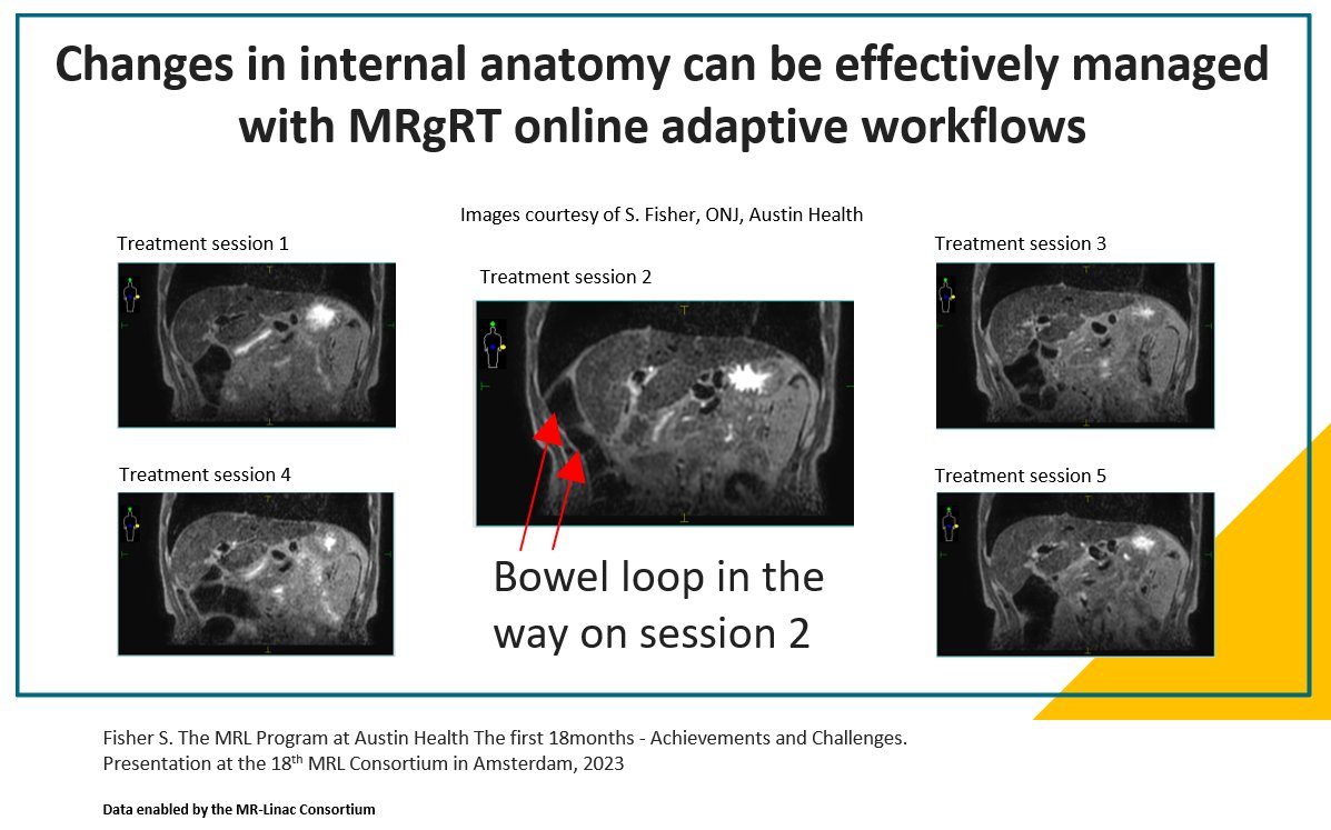 See and manage small bowel position changes with online adaptive MR-guided workflows!

mrlconsortium.org