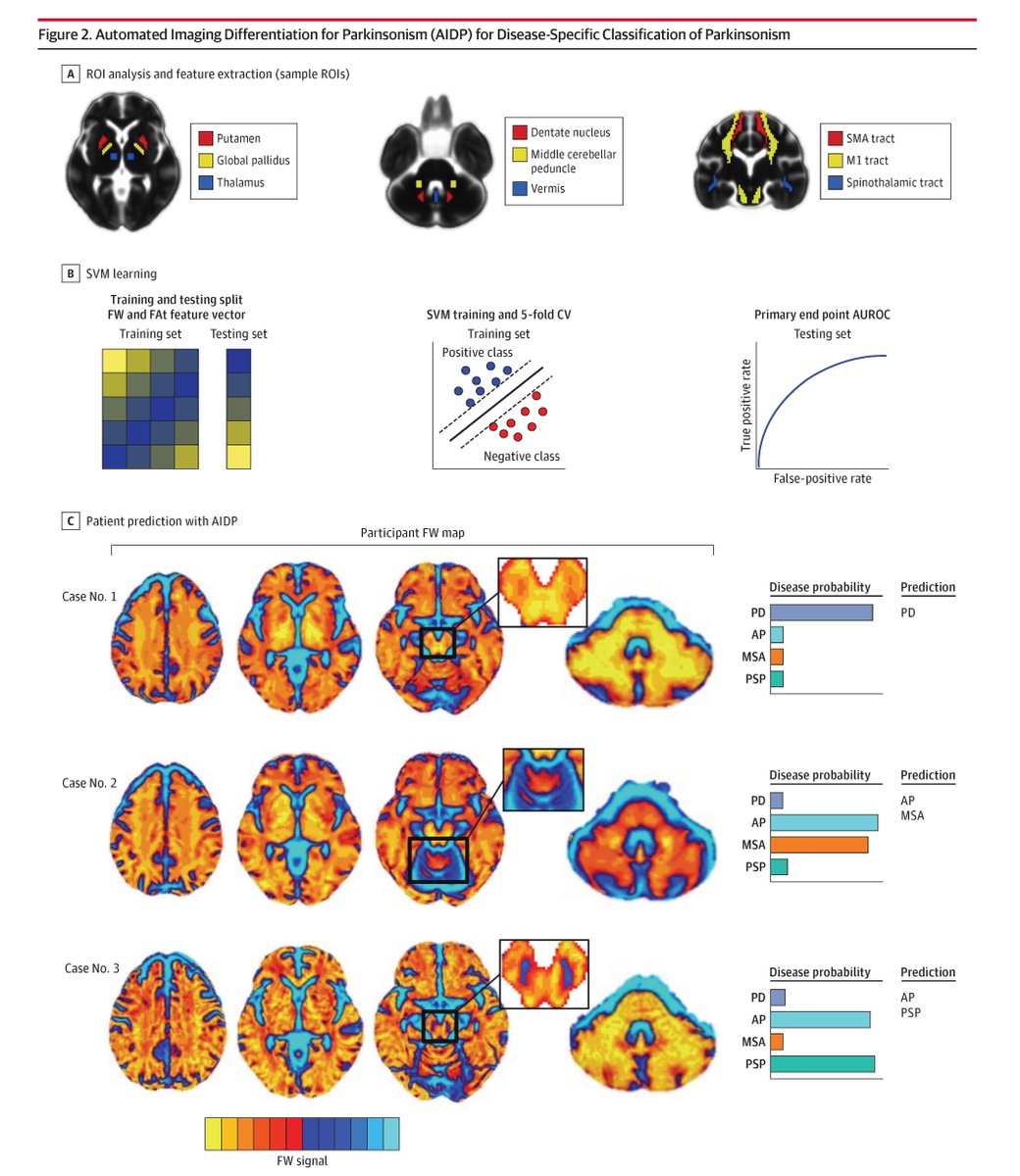 JAMANeuro's tweet image. In this study, the successful testing and validation of Automated Imaging Differentiation for Parkinsonism suggest its integration within the diagnostic workup of 3 commonly encountered neurodegenerative parkinsonian disorders. ja.ma/3RkLVNz