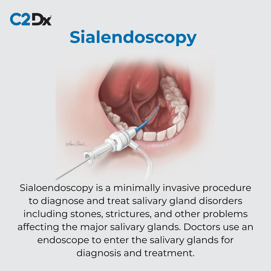 Did you know sialolithiasis accounts for half of all major salivary gland diseases? Sialendoscopy is a minimally invasive procedure that's effective in the diagnosis and treatment of salivary gland disorders like stones and strictures.