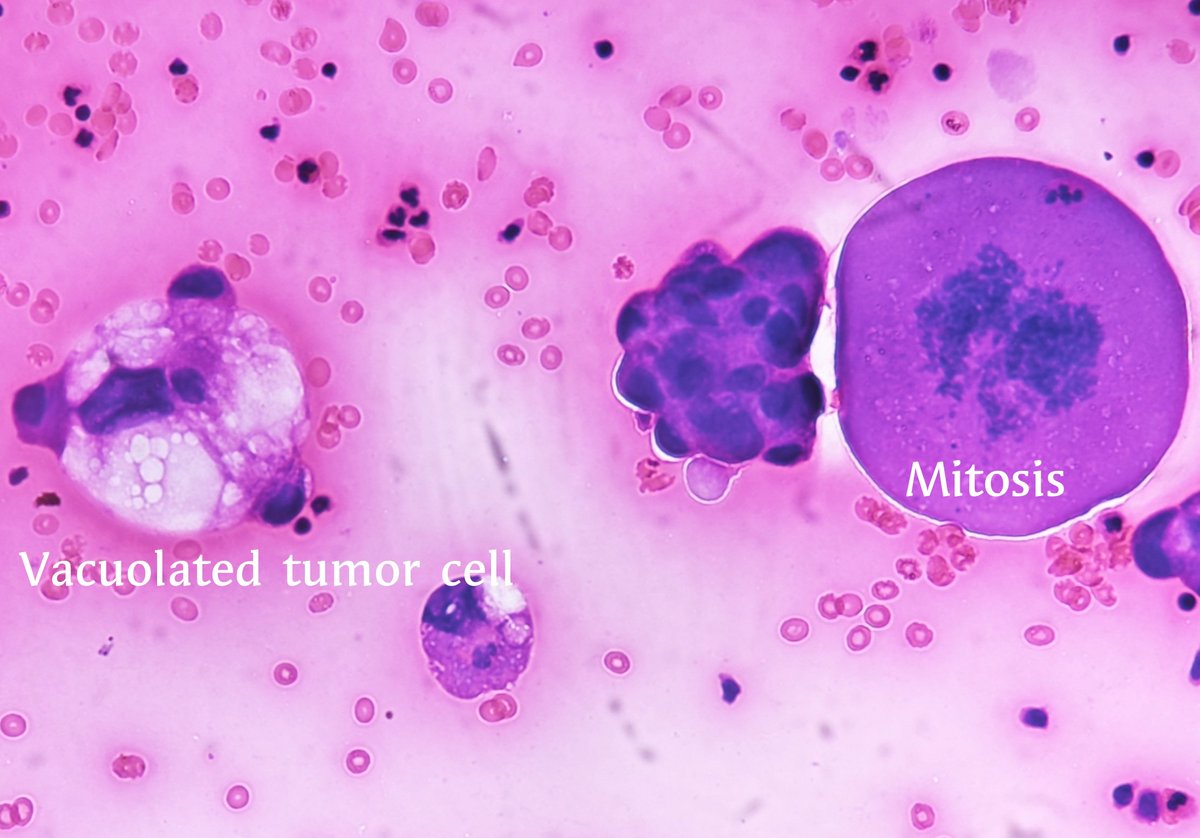 pathphyo's tweet image. Dreadful metastatic adenocarcinoma in pleural fluid with vacuolated tumor cells and mitosis. #pathology #Cytopath #malignancy