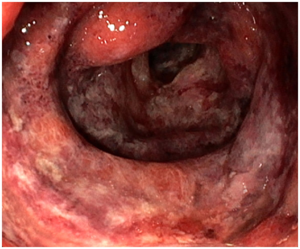 A healthy 10-year-old girl with lumbar pain, nausea, and melena was found to have duodenal &amp; jejunal ulcerations with luminal narrowing on EGD. 

What's the diagnosis? 🧐 #PedsGI #MedTwitter

🔗 onlinelibrary.wiley.com/doi/10.1002/jp…