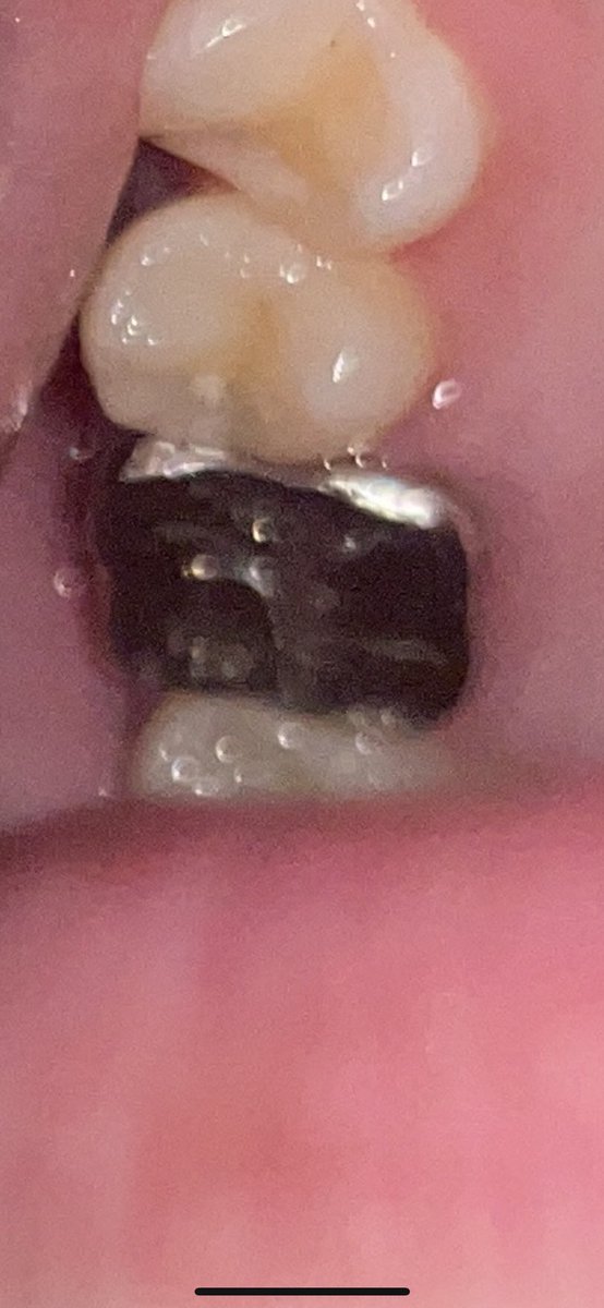 ついに治療終わりました😭