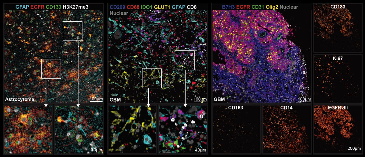 Hadeesha Piyadasa (@hadeeshap) on Twitter photo đź§µ (1/8) Today, <a href="/BenOberlton/">Benjamin Oberlton</a> and I are excited to share the preprint of our work on: A comprehensive multi-omic study of human gliomas, spanning diagnosis, treatment, and recurrence. We address the longstanding challenge of developing effective therapies for gliomas, which have đź§µ (1/8) Today, <a href="/BenOberlton/">Benjamin Oberlton</a> and I are excited to share the preprint of our work on: A comprehensive multi-omic study of human gliomas, spanning diagnosis, treatment, and recurrence. We address the longstanding challenge of developing effective therapies for gliomas, which have