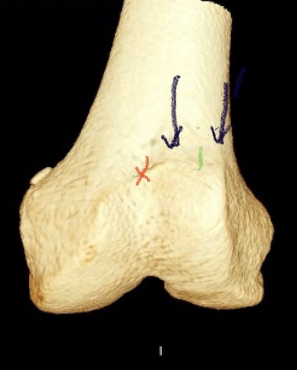 Save this dysplastic flat proximal trochlea of a recurrent patella dislocator. Just move the patella closer to the groove. Simple and joint preserving. Tried and true. No trochleoplasty needed