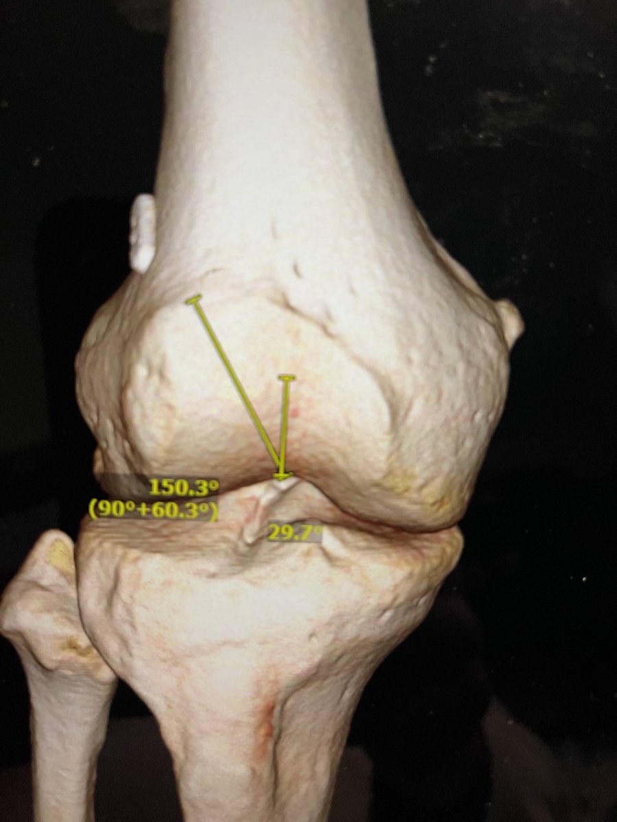 TTTNT=Tibial tubercle transfer no trochleoplasty
Or:  move to it, don’t groove it. Joint preservation always