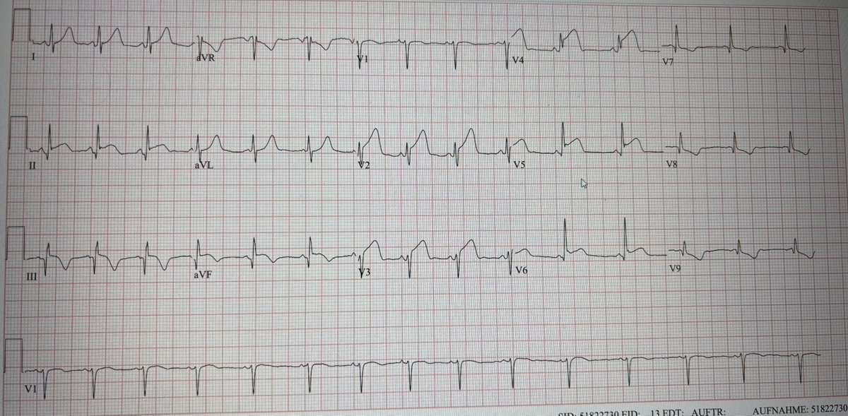 #ECG #Cardiology 

31 year old male patient with chest pain on and off for the last  24h . Similar episodes one week ago . No known cardiovascular risk factors . Urgent Cath or MRI ?  Or maybe sth else ?