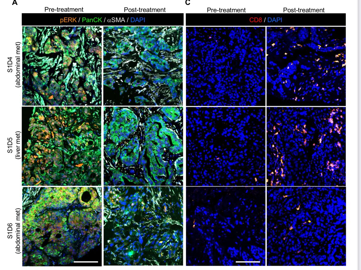 Anirban Maitra (@aiims1742) on Twitter photo A true “farm to table” effort at <a href="/MDAndersonNews/">MD Anderson Cancer Center</a> funded by our #PancreaticCancer Moonshot.
The 1st clinical trial of systemic exosomes targeting mutant KRAS in metastatic pancreatic cancer.
Five years from <a href="/rkalluriMDPhD/">Raghu Kalluri</a> discovery to patients.
No DLTs whatsoever to speak of. A true “farm to table” effort at <a href="/MDAndersonNews/">MD Anderson Cancer Center</a> funded by our #PancreaticCancer Moonshot.
The 1st clinical trial of systemic exosomes targeting mutant KRAS in metastatic pancreatic cancer.
Five years from <a href="/rkalluriMDPhD/">Raghu Kalluri</a> discovery to patients.
No DLTs whatsoever to speak of.