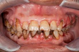 As I sit down to write this post,my heart is heavy with sadness.I've seen firsthand the devastating affects of gum disease on poor kids in our schools and communities.