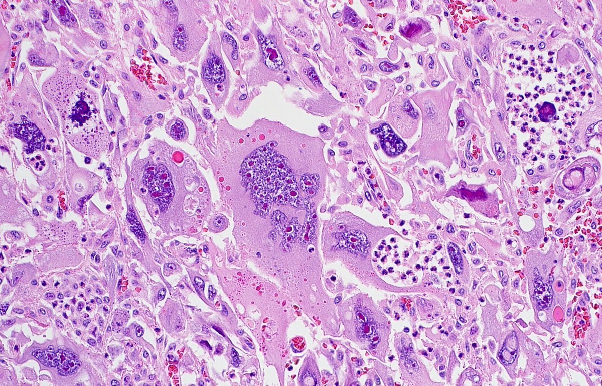 I call this kind of cell a "Ginormo-Cyte"! Large thigh mass in an adult
Answer ✅ youtu.be/PLnwikIK1JY?si… 
More pics: kikoxp.com/posts/10213. 
How I work up pleomorphic spindle cell tumors: youtu.be/SLbQNYy4B28?si… 
#BSTpath #pathologists #pathology #pathTwitter #dermpath
