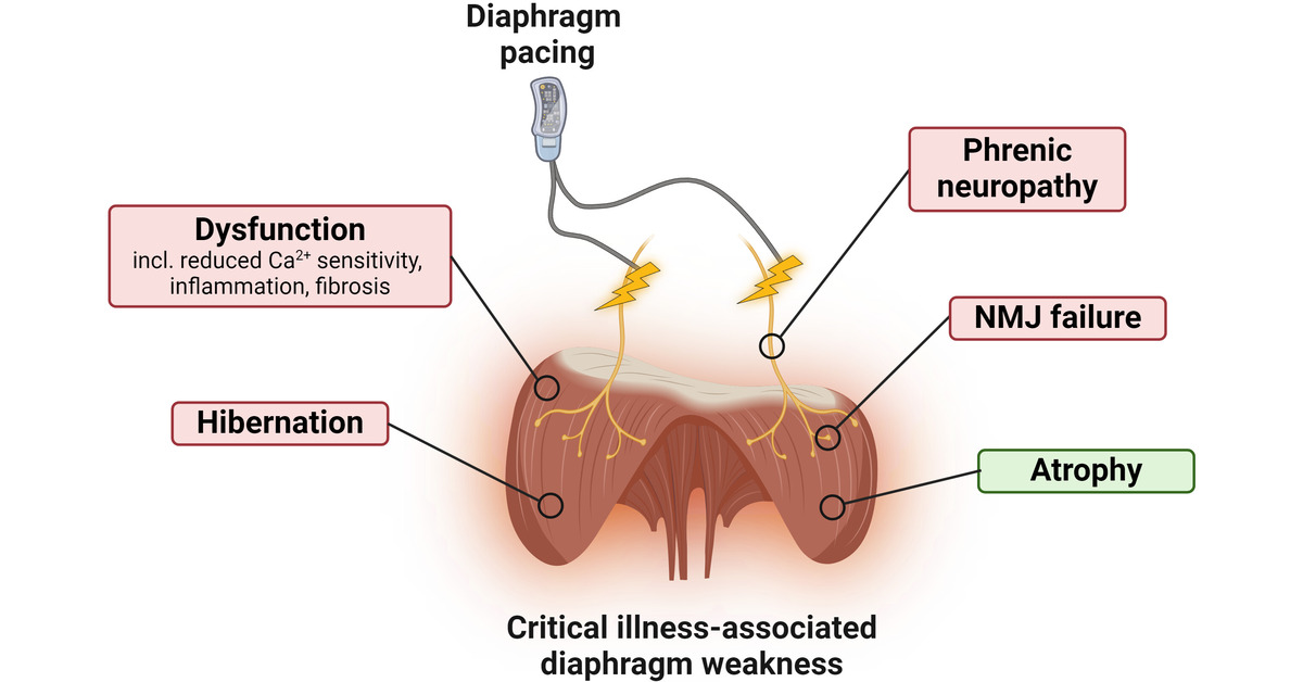ATS Blue Journal (@atsblueeditor) on Twitter photo Diaphragm Pacing in Early Critical Illness? A Plea for a Super-Relaxed Approach
Electrical pacing of the diaphragm is an attractive intervention to prevent diaphragm weakness. But what does physiology tell us? Relax!
<a href="/DrLeoHeunks/">Leo Heunks</a>
<a href="/DrJonneDoorduin/">Jonne Doorduin</a>
🔗 tinyurl.com/y66t72wp Diaphragm Pacing in Early Critical Illness? A Plea for a Super-Relaxed Approach
Electrical pacing of the diaphragm is an attractive intervention to prevent diaphragm weakness. But what does physiology tell us? Relax!
<a href="/DrLeoHeunks/">Leo Heunks</a>
<a href="/DrJonneDoorduin/">Jonne Doorduin</a>
🔗 tinyurl.com/y66t72wp