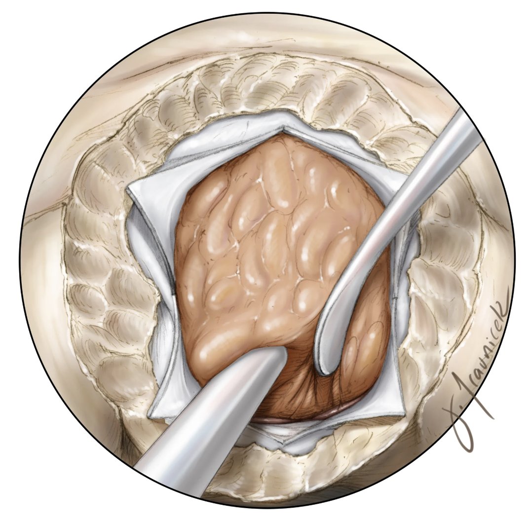 Devascularization In parasellar meningioma resection, the first step after the exposure ...