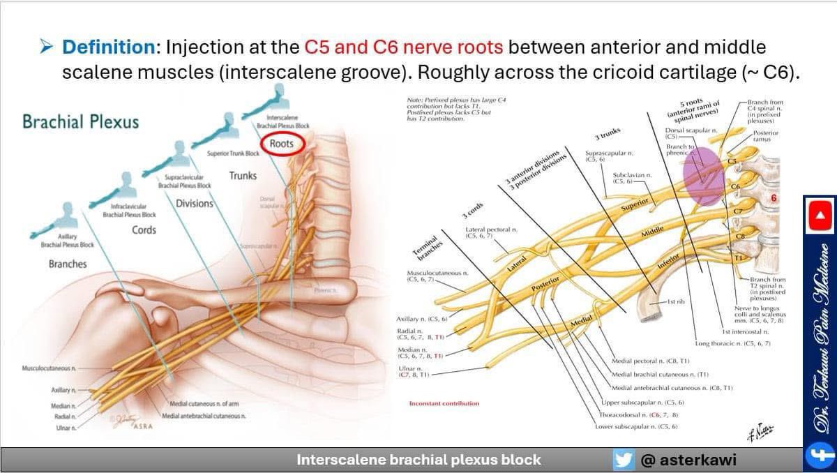asterkawi's tweet image. Brachial Plexus Blocks: When? Where? How? Why?
youtu.be/sRJ32EqPDnQ

#Brachialplexus #InterscaleneBlock #SuperiorTrunkBlock #SupraclavicularBlock #InfraclavicularBlock #AxillaryBlock #regionalanesthesia