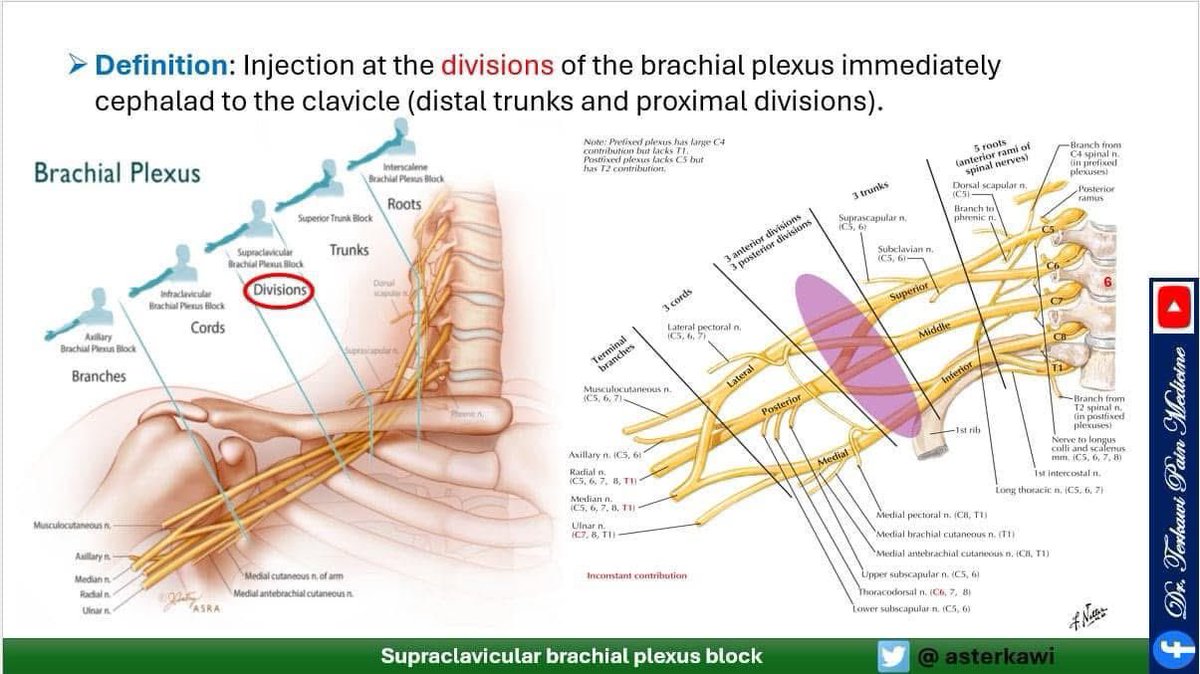 asterkawi's tweet image. Brachial Plexus Blocks: When? Where? How? Why?
youtu.be/sRJ32EqPDnQ

#Brachialplexus #InterscaleneBlock #SuperiorTrunkBlock #SupraclavicularBlock #InfraclavicularBlock #AxillaryBlock #regionalanesthesia
