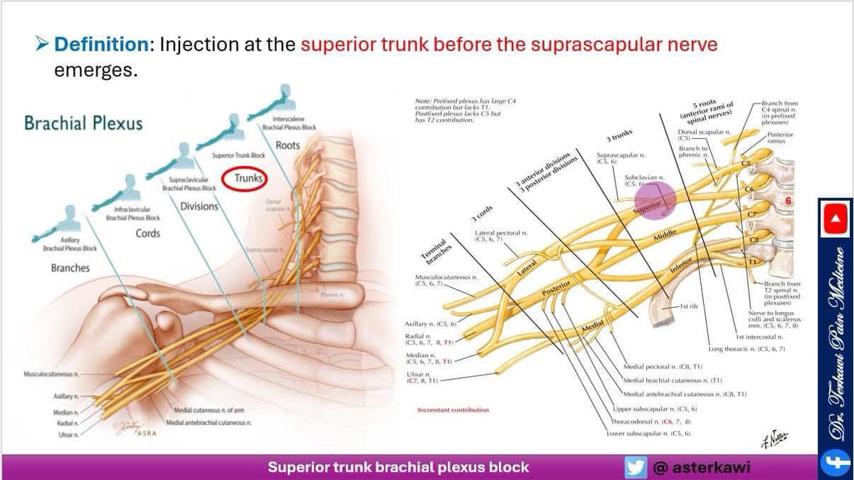 asterkawi's tweet image. Brachial Plexus Blocks: When? Where? How? Why?
youtu.be/sRJ32EqPDnQ

#Brachialplexus #InterscaleneBlock #SuperiorTrunkBlock #SupraclavicularBlock #InfraclavicularBlock #AxillaryBlock #regionalanesthesia