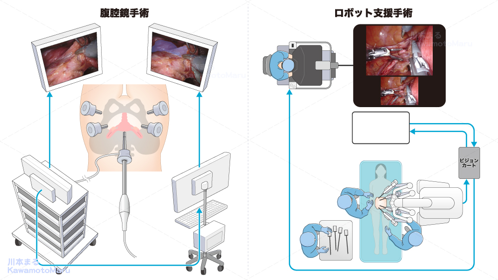 AIを活用した腹腔鏡手術・ロボット手術の概念図です（2024年)