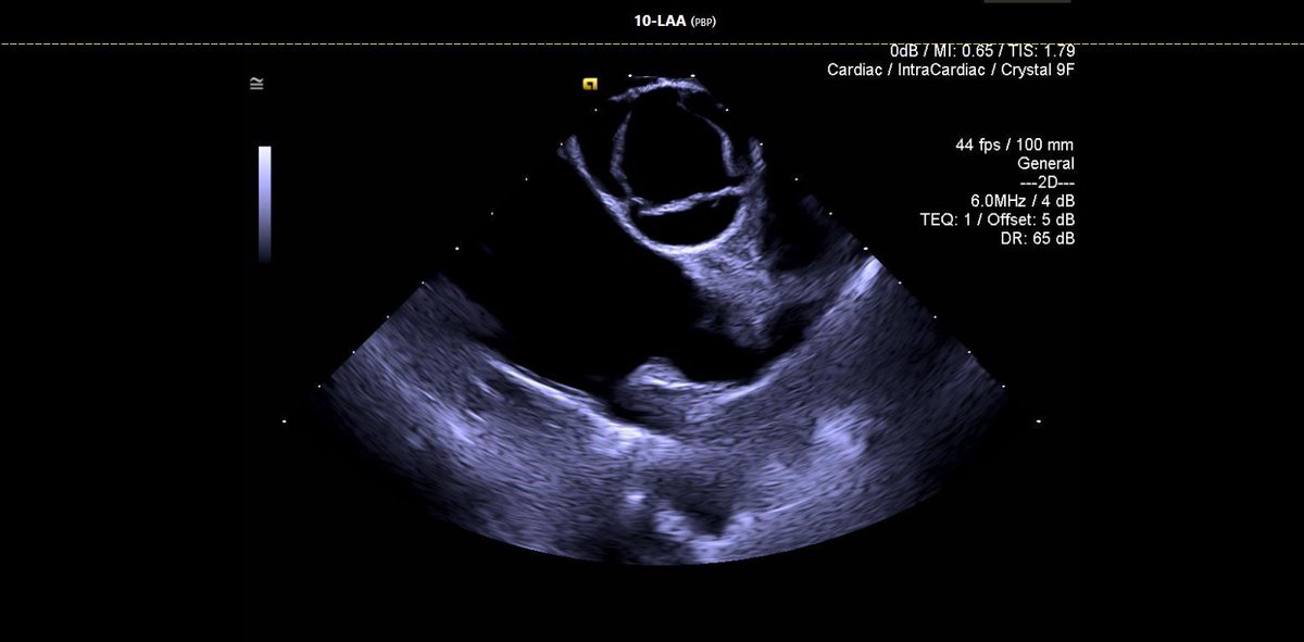 Mdmetzl's tweet image. The OG Soundstar and the iPhone were both released in 2007. At long last, I can tell you the Crystal ICE Soundstar catheter is real and it’s awesome. @jnazarimd @EndeavorHlth @JNJMedTech