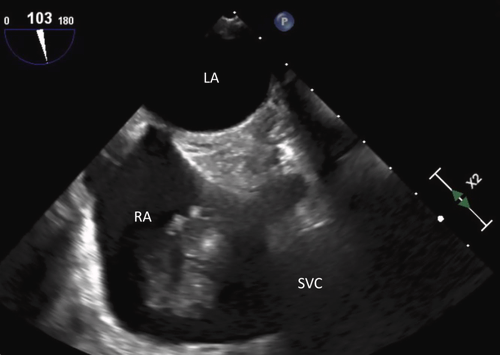 Zach Rozenbaum MD (@rozenbaum_z) on Twitter photo How fast does a myxoma regrow after percutaneous aspiration <a href="/JACCJournals/">JACC Journals</a> <a href="/ACCinTouch/">American College of Cardiology</a> jacc.org/doi/10.1016/j.… <a href="/ericgnall/">Eric</a> <a href="/GilbertTangMD/">Dr. Gilbert Tang</a> <a href="/DeeDeeWangMD/">Dee Dee Wang MD</a> <a href="/MinnowWalsh/">Minnow Walsh, MD, MACC</a> How fast does a myxoma regrow after percutaneous aspiration <a href="/JACCJournals/">JACC Journals</a> <a href="/ACCinTouch/">American College of Cardiology</a> jacc.org/doi/10.1016/j.… <a href="/ericgnall/">Eric</a> <a href="/GilbertTangMD/">Dr. Gilbert Tang</a> <a href="/DeeDeeWangMD/">Dee Dee Wang MD</a> <a href="/MinnowWalsh/">Minnow Walsh, MD, MACC</a>