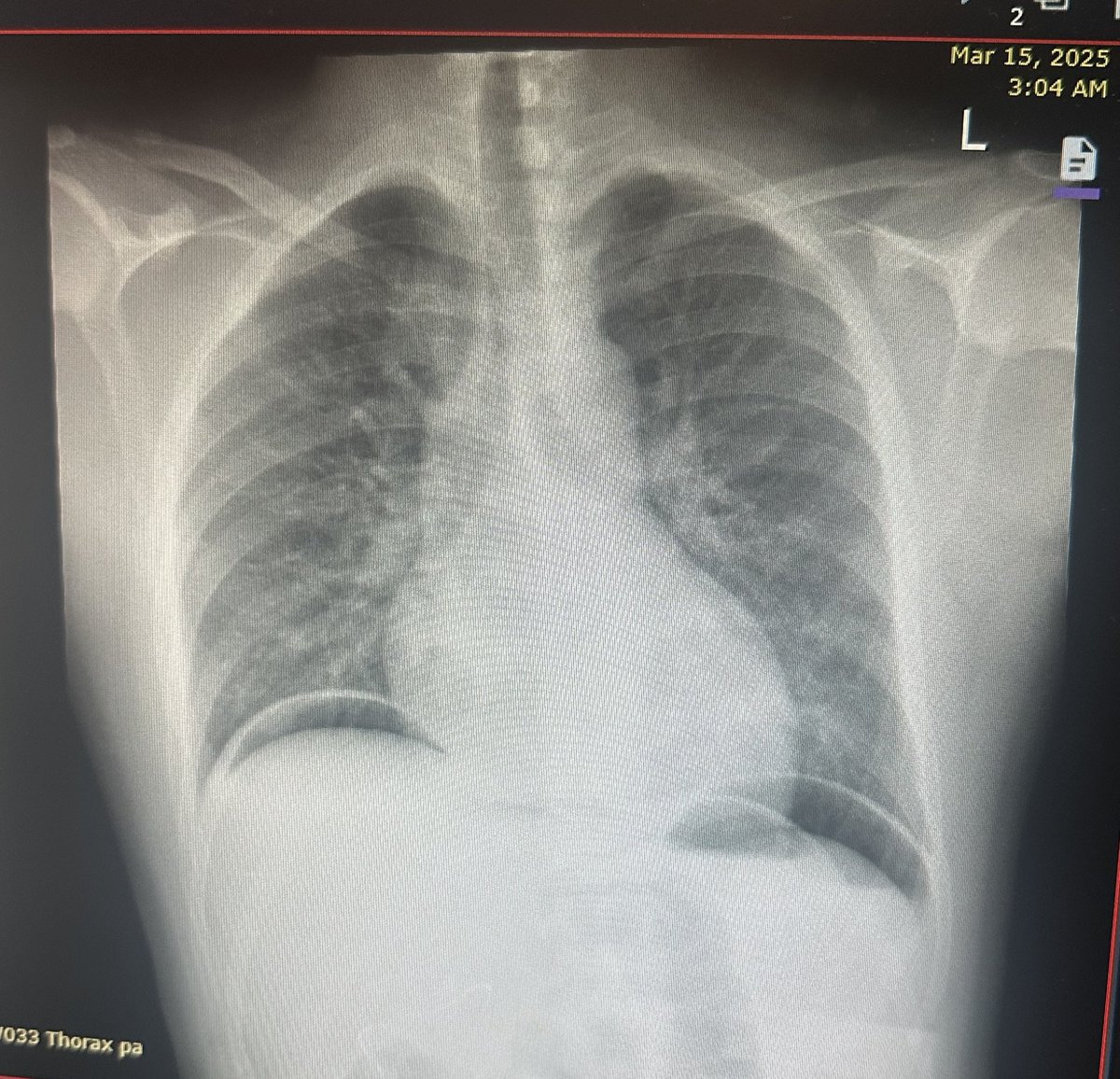 hemo_shk's tweet image. What is the diagnosis or differential diagnosis?
#Findings
#Causes

#MEDHM #MedX @IhabFathiSulima