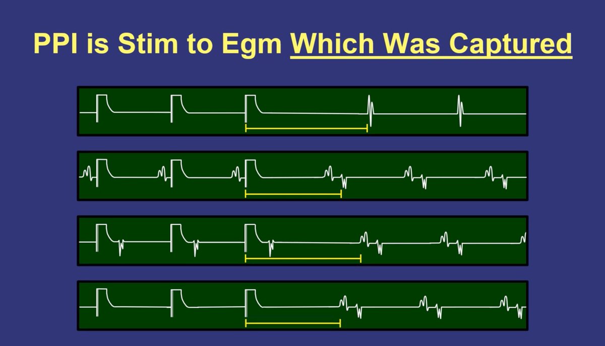 In the VT entrainment video, we talk about how to measure post pacing interval in the context of complex egms.