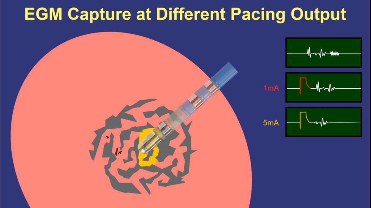 In the VT entrainment video, we talk about complex scar, egms, pacing output.