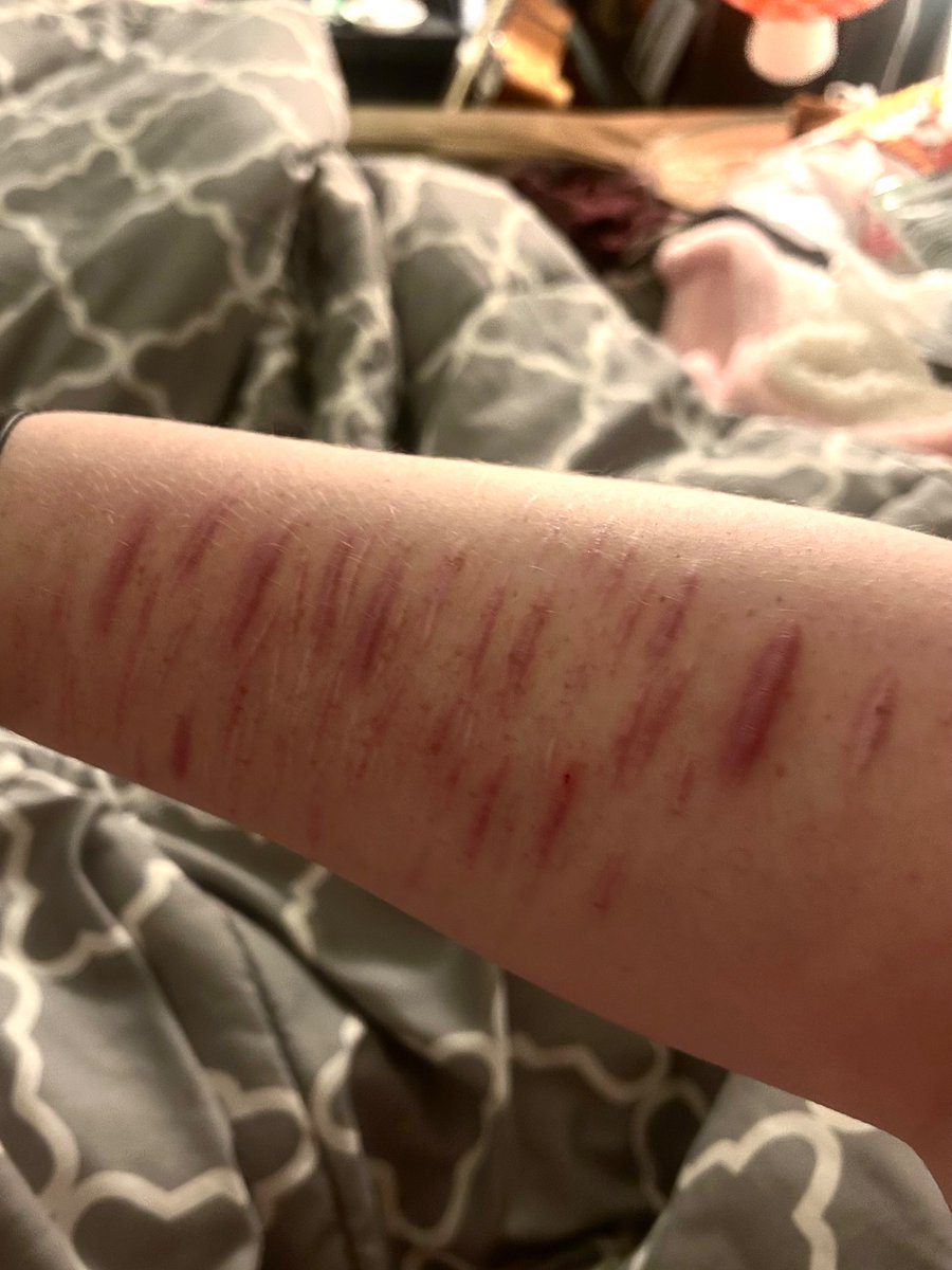 forrest_143's tweet photo. scars 
#shtwt 
i cant cut my wrists bc my parents will see BUT I NEED TO SO BAD SHFKGK https://t.co/zdtkO9rOvS