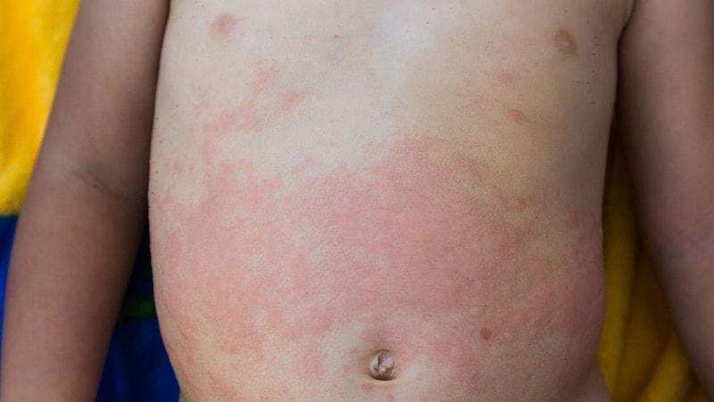 Three-year-Old Has Nightly Fever, Lymphadenopathy, and Rash
ms.spr.ly/6016qMG5E