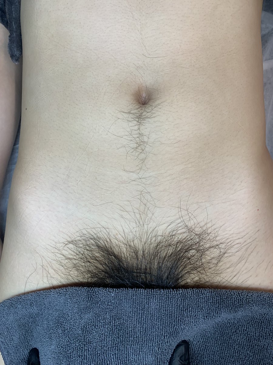 길고 지저분했던 털들을 깔끔하게✨

✓ 남자 원장님의 1:1 맞춤 예약 관리
✓ 시술 후 모든 기구, 용품 소독 및 1회 용품 사용
✓ 샤워실 완비
​✓ 당일 예약 가능

 문의 : open.kakao.com/o/sXF03Mzf

#인천남자왁싱 #남자왁서 #인하대 #부평 #주안